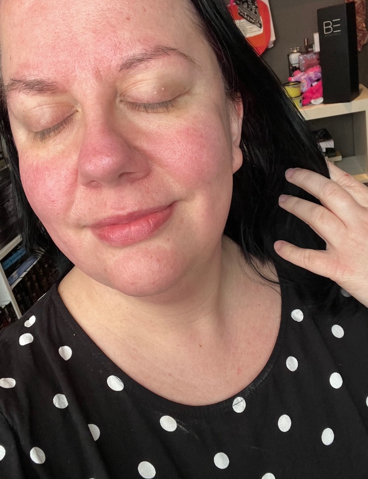 Wat is rosacea en hoe ga je ermee om?
